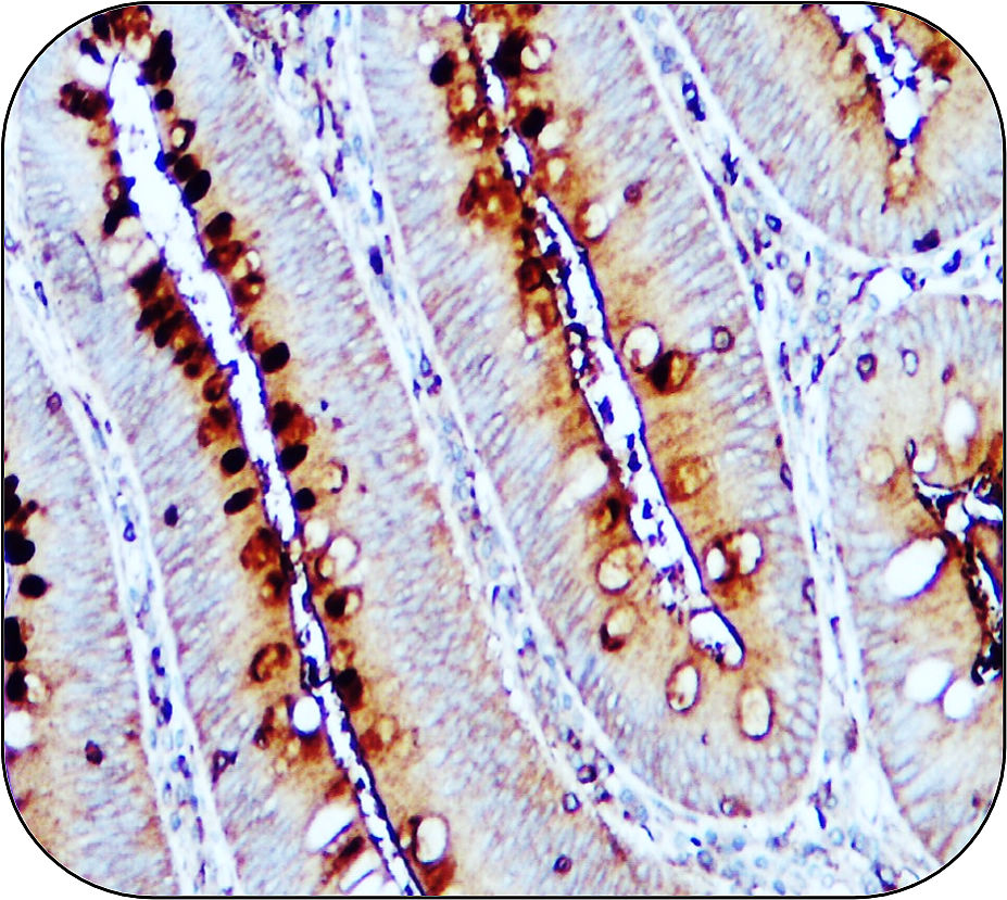 IR108-442 anti-VEGF antibody_Colorectal carcinoma IHC image