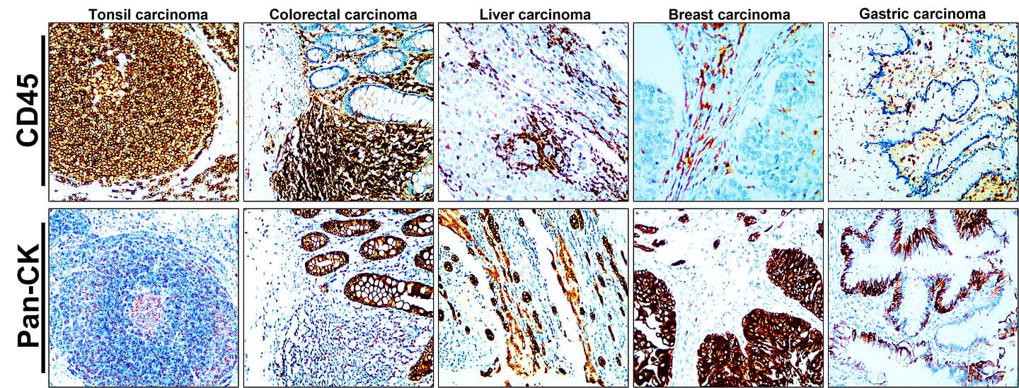 Third party verification for Clinical IHC CD45 Pan-ck tonsil colorectal liver breast gastric