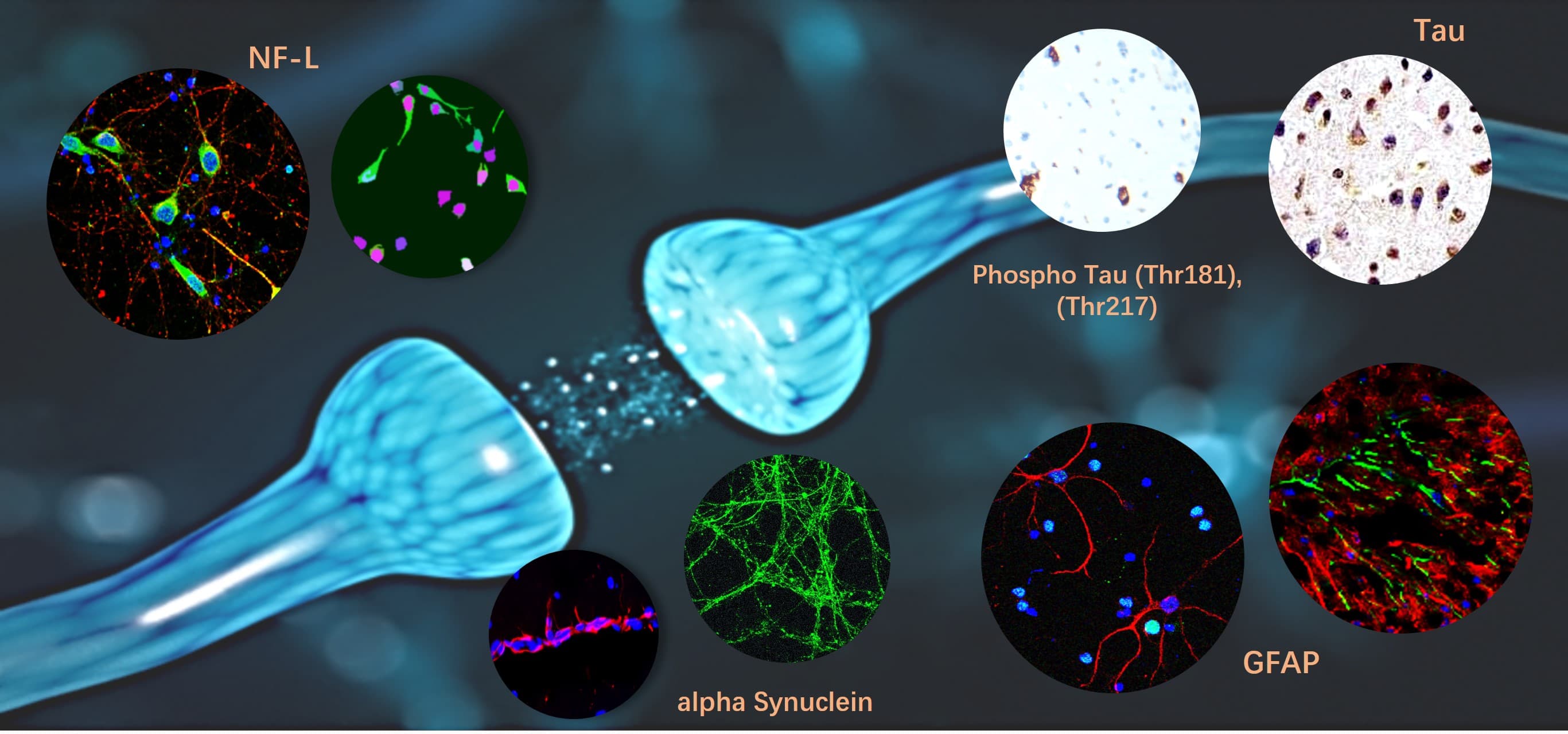 Neurodegenerative  Alzheimer's disease (AD) marker