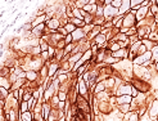 Customer feedback Image IR55-180 anti-E cadherin antibody IHC image