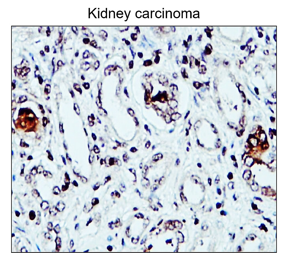 IR48-147 anti-Fibronectin antibody_Kidney carcinoma IHC image