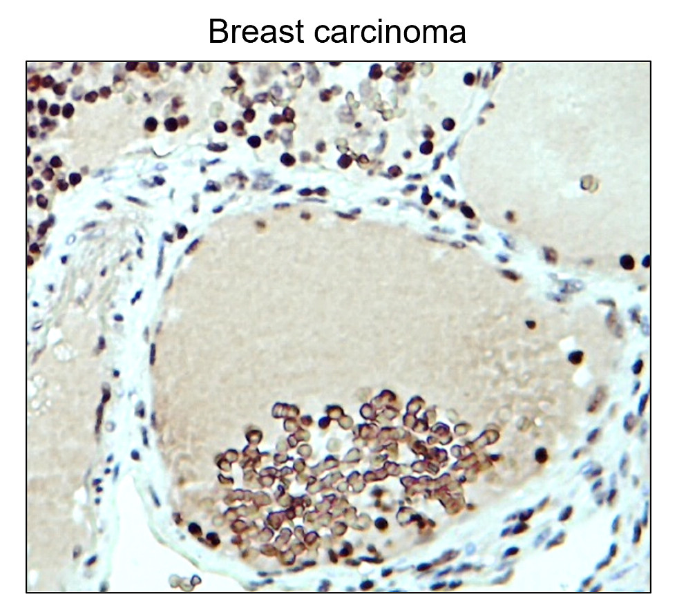 IR48-147 anti-Fibronectin antibody_Breast carcinoma IHC image