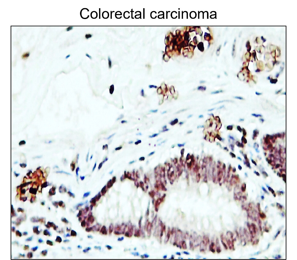 IR48-147 anti-Fibronectin antibody_Colorectal carcinoma IHC image