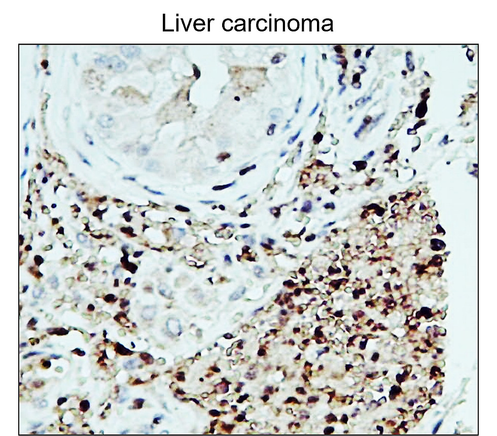 IR48-147 anti-Fibronectin antibody_Liver carcinoma IHC image