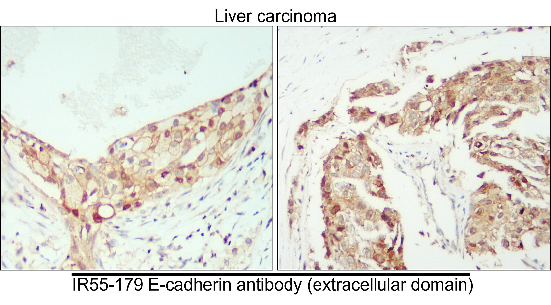 IR55-179 anti-E cadherin antibody_Liver carcinoma IHC image