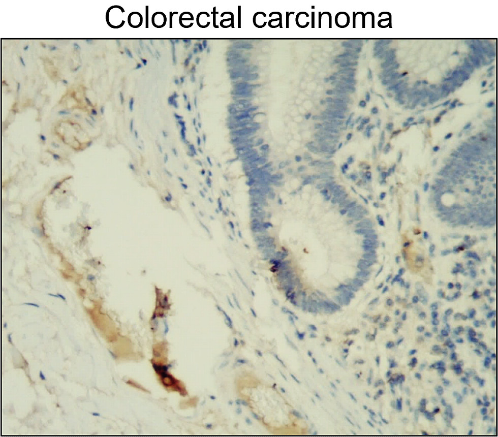 IR67-227 anti- MMP2 antibody_Colorectal carcinoma IHC image