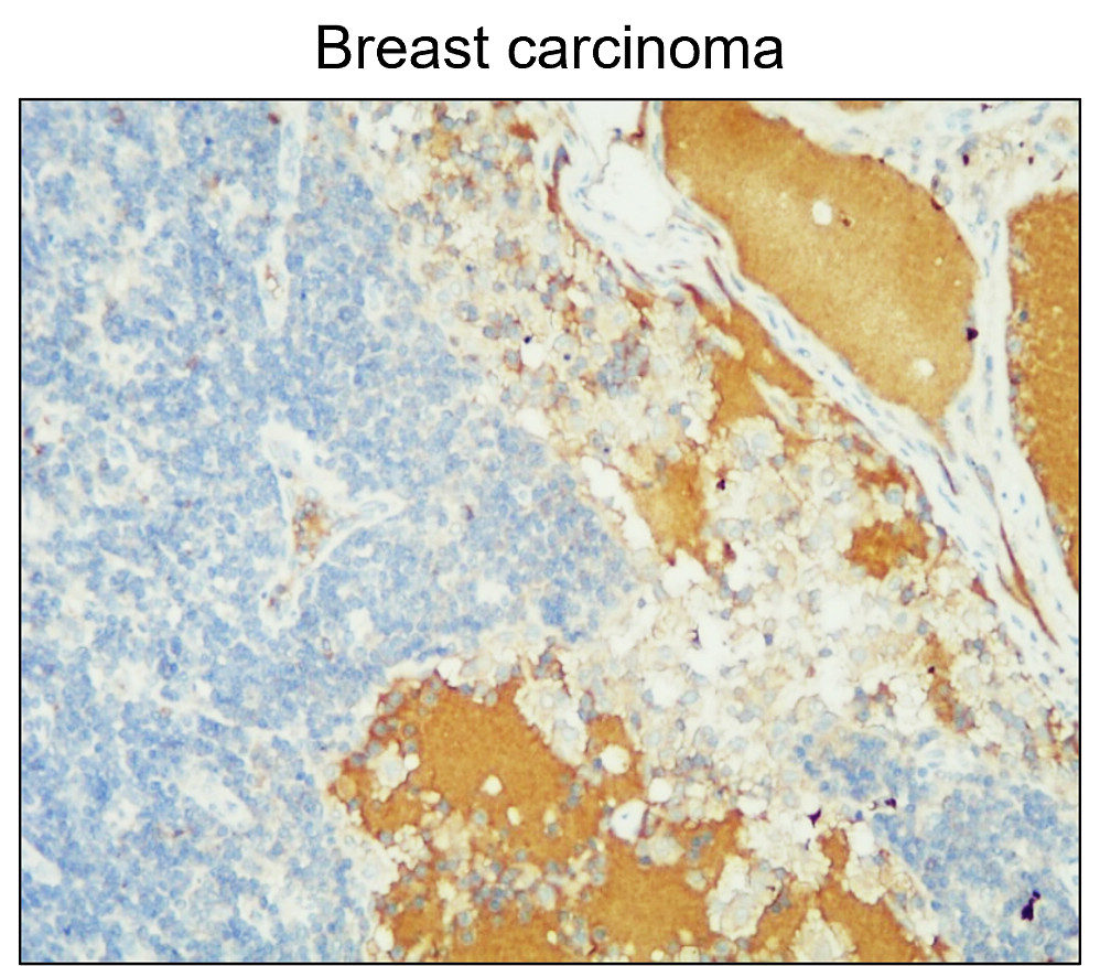 IR71-245 anti- MMP14 / MT1-MMP antibody_Breast carcinoma IHC image