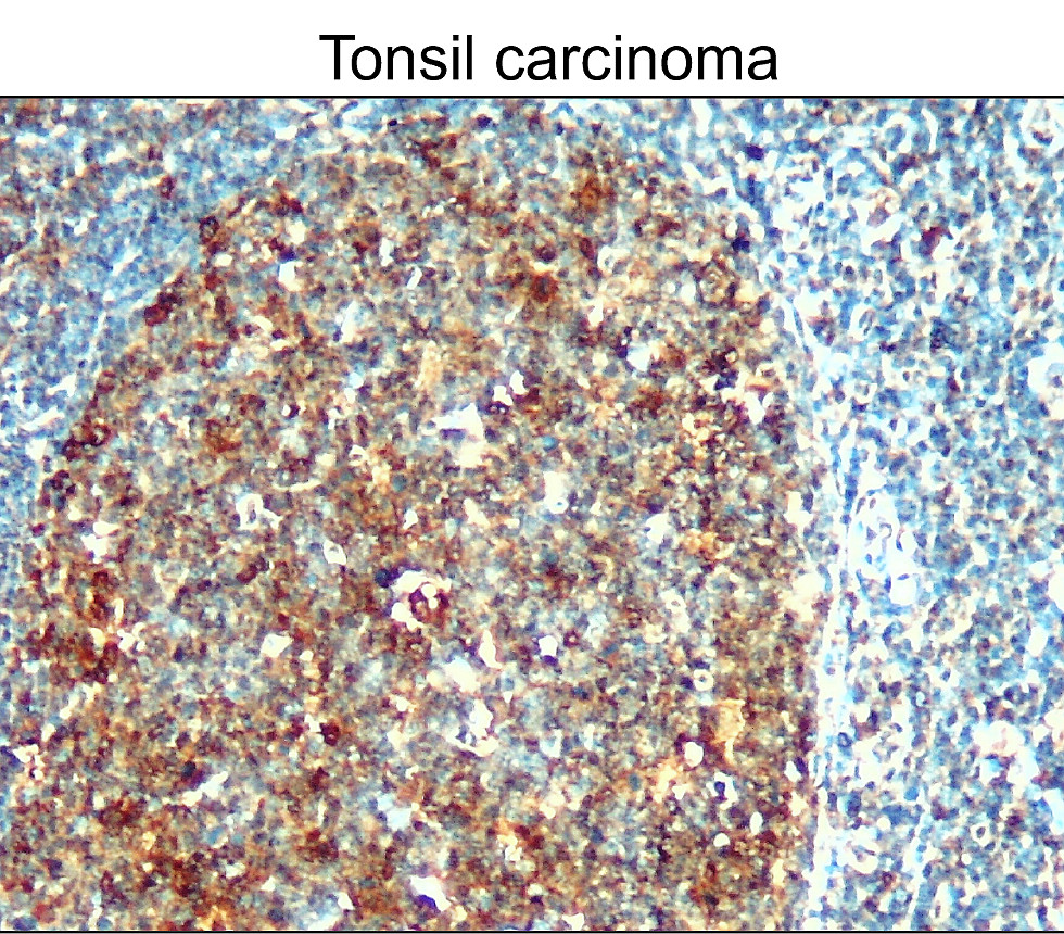 IR102-426 anti-Survivin / BIRC5 antibody_Tonsil carcinoma IHC image