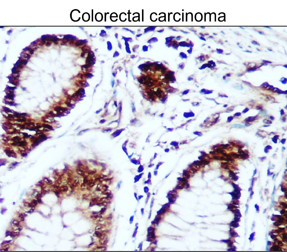 IR102-426 anti-Survivin / BIRC5 antibody_Colorectal carcinoma IHC image