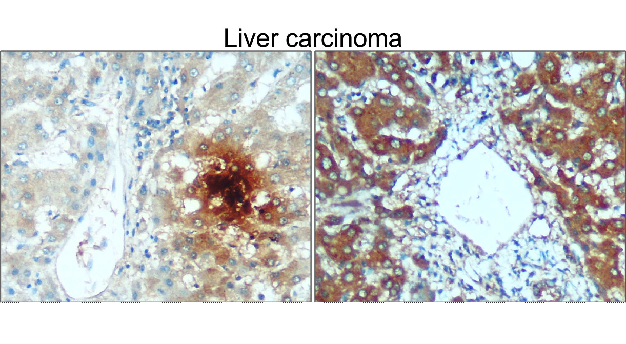 IR106-P2 anti-TNF alpha antibody_Liver carcinoma IHC image