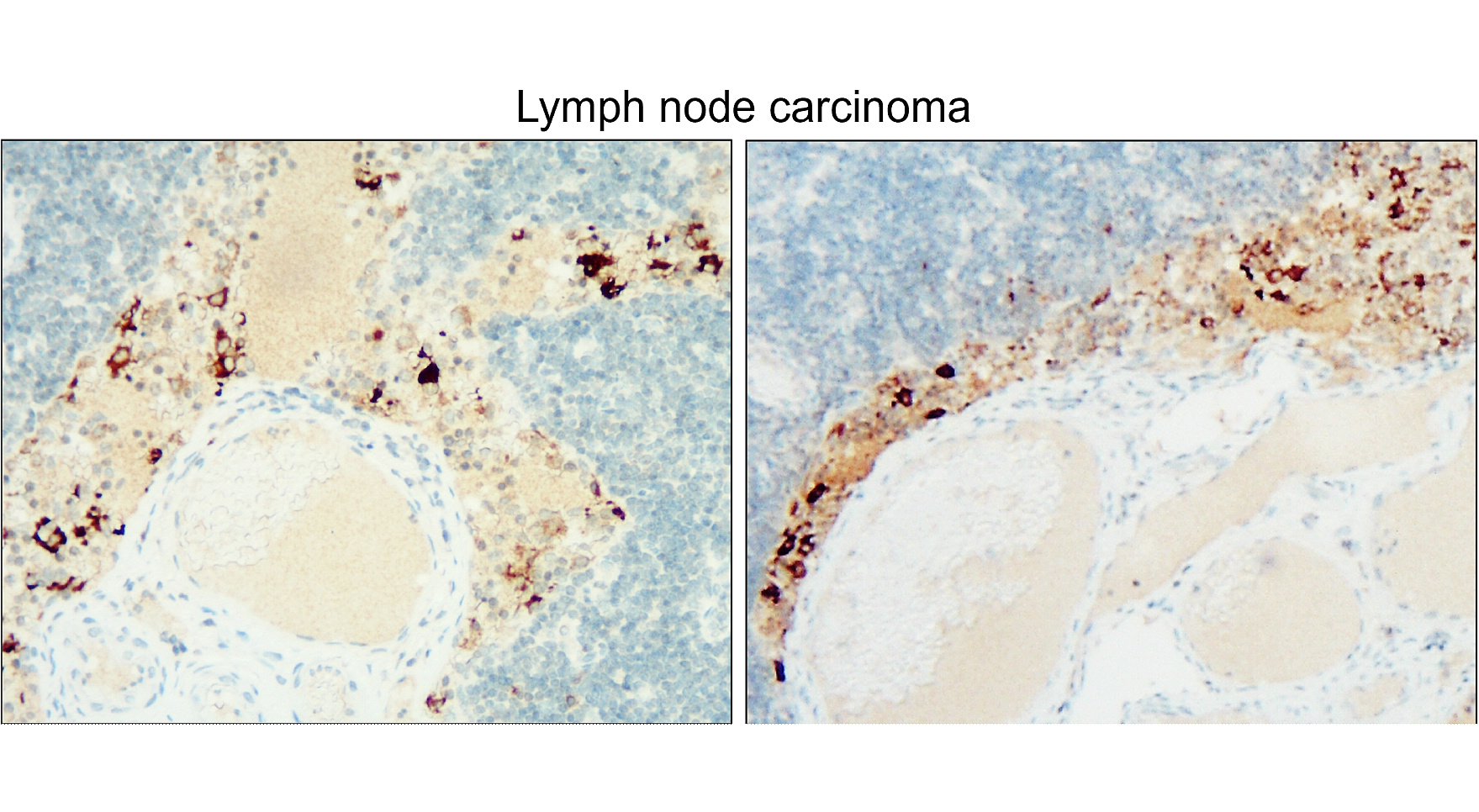 IR30-78 anti- CD133 / Prominin-1 antibody_Lymph node carcinoma IHC image