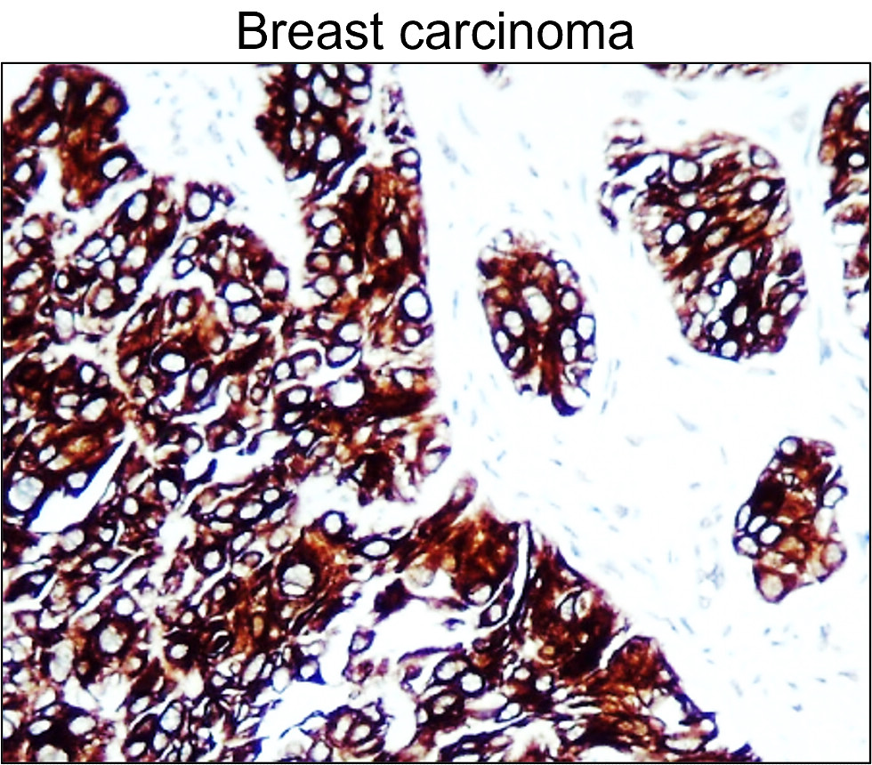 IR228-868 anti-Cytokeratin 7 antibody_Breast carcinoma IHC image