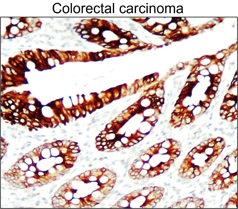 IR228-868 anti-Cytokeratin 7 antibody_Colorectal carcinoma IHC image