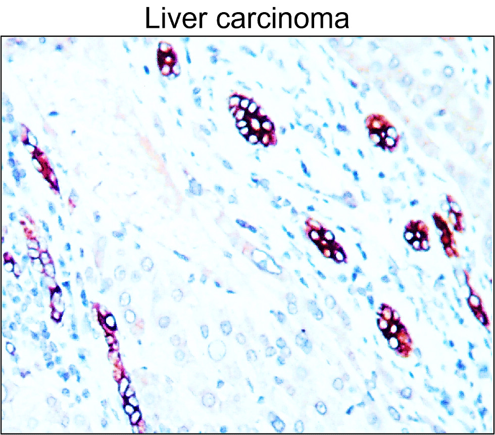 IR228-868 anti-Cytokeratin 7 antibody_Liver carcinoma IHC image