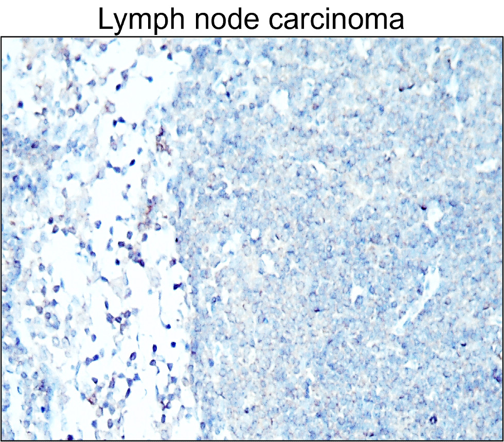 IR228-868 anti-Cytokeratin 7 antibody_Lymph node carcinoma IHC image