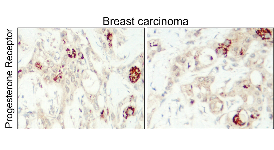 IR215-787 anti- Progesterone Receptor antibody IHC image