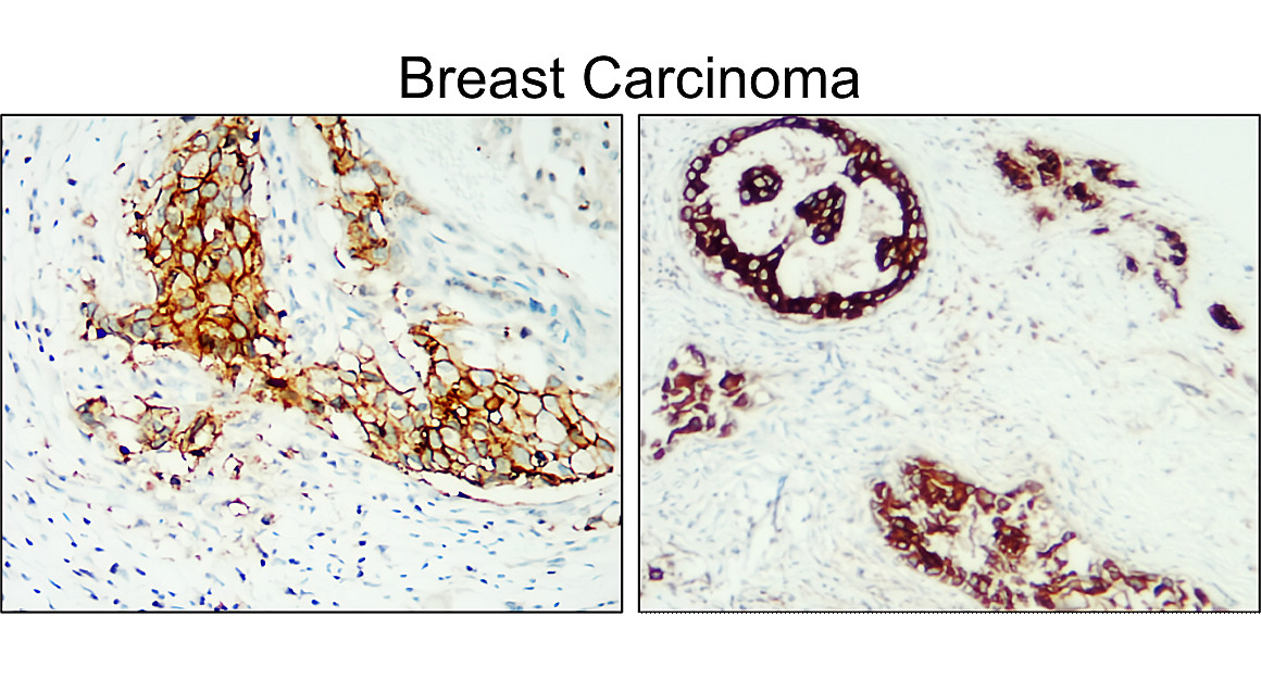 IR210-763 anti-HER2 / ERBB2 antibody_Breast carcinoma IHC image