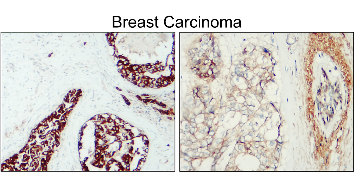 IR210-763 anti-HER2 / ERBB2 antibody_Breast carcinoma IHC image