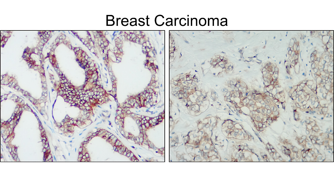 IR210-763 anti-HER2 / ERBB2 antibody_Breast carcinoma IHC image