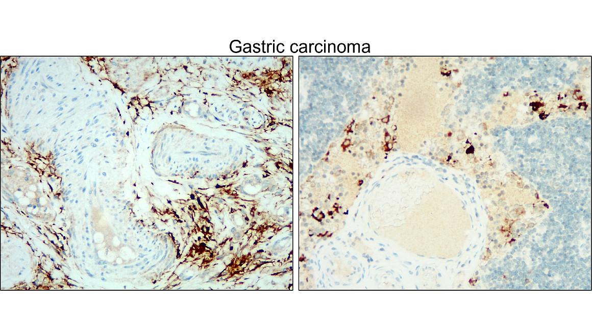 IR30-78 anti- CD133 / Prominin-1 antibody_Castric carcinoma IHC image	