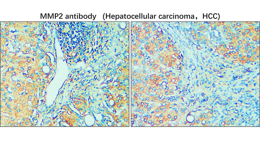 IR67-228 anti- MMP2 antibody [c-term]_Hepatocellular carcinoma IHC image