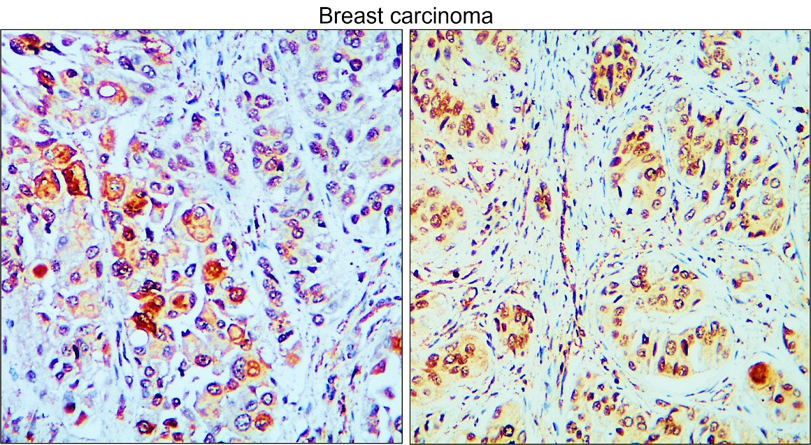 IR219-807 anti c-MET antibody_Breast carcinoma IHC image