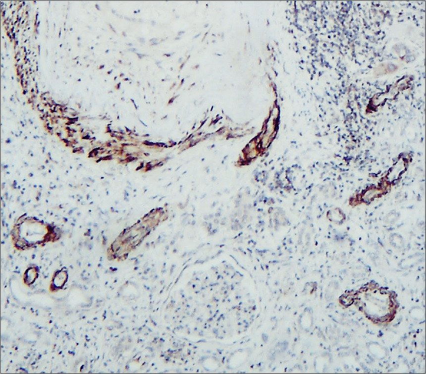 IR66-225 anti-MMP1 antibody IHC image