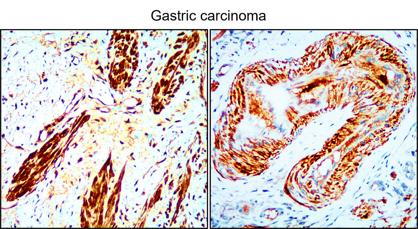 IR93-390 anti-BAX antibody_Gastric carcinoma IHC image