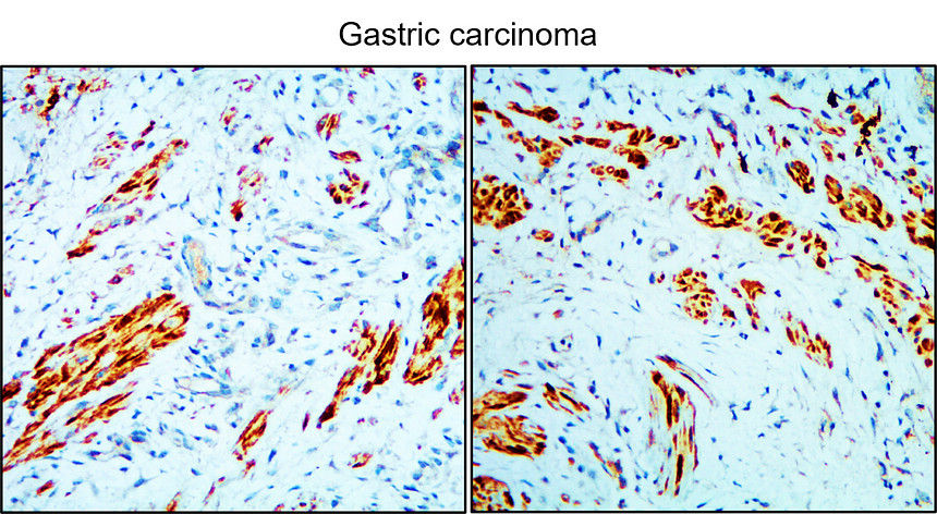 IR93-390 anti-BAX antibody_Gastric carcinoma IHC image